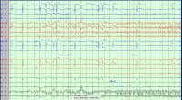 Ictal Headache | RM. Ictal Headache | RM.