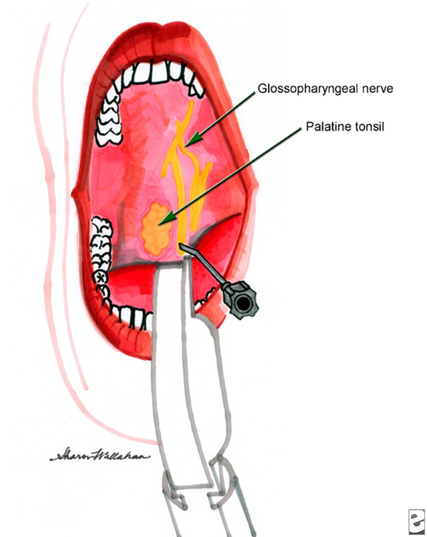 glossopharyngeal sulcus