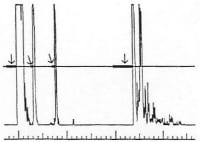 Biometry Eye