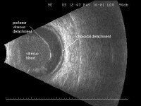 B-Scan Ocular Ultrasound: Overview, Indications For Examination ...