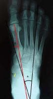 Calcaneal Inclination