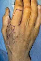 Dorsal Metacarpal Artery