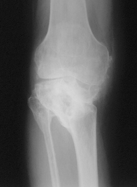 Osteoarthritis Of Knee. in of Osteoarthritis+knee