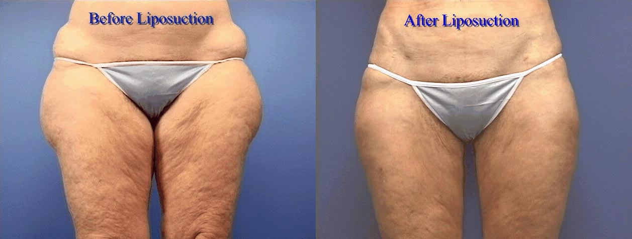 Before and after views of liposuction of thighs a.