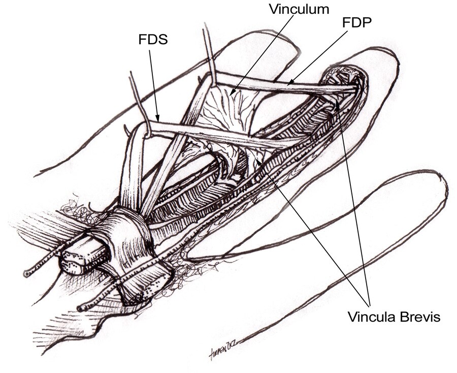 Tendons In Hand. hand tendons flexor