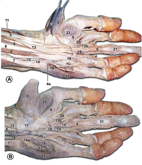 In B, the flexor retinaculum is intact. Number 5 is the flexor carpi 