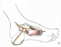 Fasciocutaneous Flap