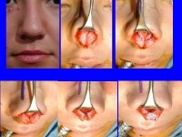 Bulbous Rhinoplasty