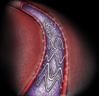 TAXUS Express paclitaxel-eluting coronary stent. 