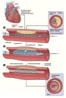 Deployment of stent in area of significant stenosi