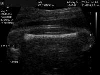 Femur Length Ultrasound