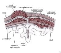 Subgaleal Haematoma