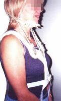 Sternal-occipital-mandibular immobilizer (SOMI) b...