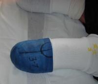Above-Knee Amputation Prosthesis