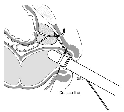 Increased pain during apical biopsy is caused by piercing of anal pain 