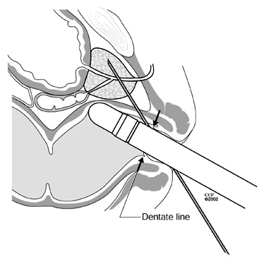 Increased pain during apical biopsy is caused by piercing of anal pain 