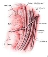 Iliac Ligaments