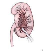 lower kidney pole