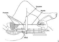 Brachytherapy Prostate