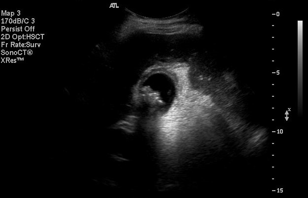 normal gallbladder ultrasound images. +ultrasound Gall bladder