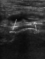 Ultrasonographic image of popliteal vessels with c