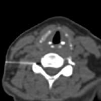 Ct guided epidural steroid injection