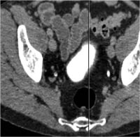 what is a ct urogram excretory phase with contrast
