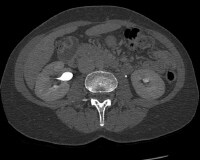 what is a ct urogram excretory phase with contrast