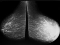 Mammogram Technique