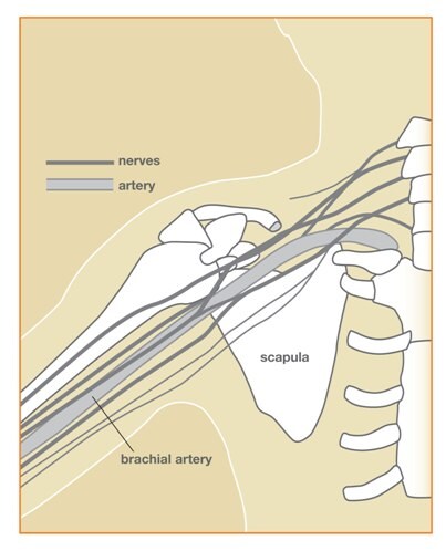 Diagram showing relationships of the brachial plexus (BP) to the sternum, 