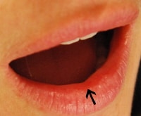 Red Patch Below Mouth Ulcer