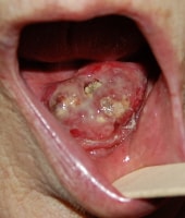 hpv on uvula