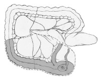 Open Right Hemicolectomy Technique: Approach Considerations, Open Right ...