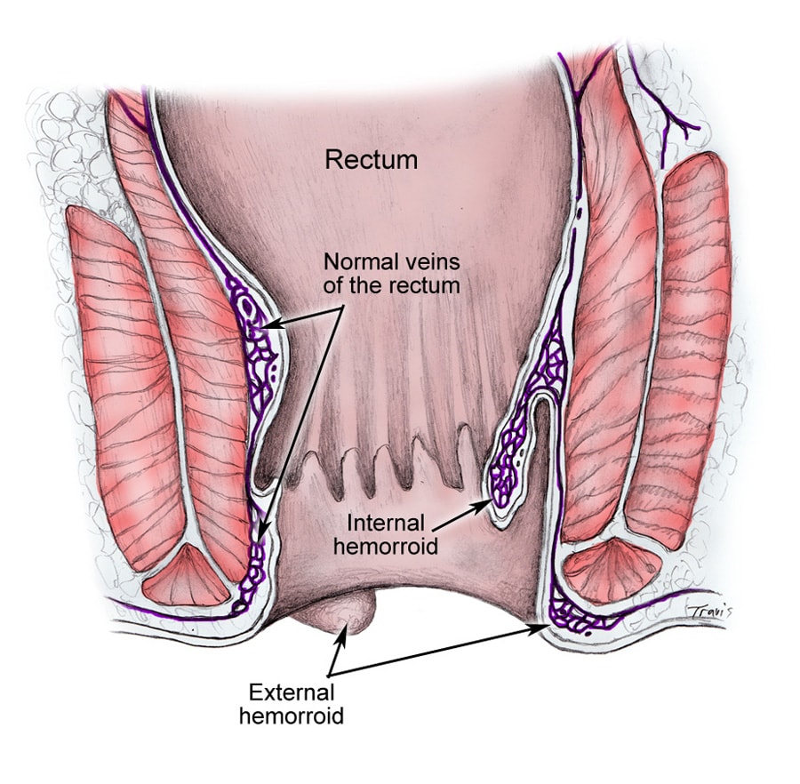 hemorrhoids external