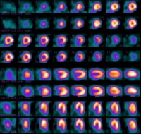 Normal radionuclide uptake (dipyridamole-Cardiolit