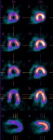 Motion abnormalities in inferior wall consistent w