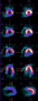 Motion abnormalities in inferior wall consistent w