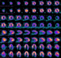 Inferobasal fixed defect and lateral wall ischemia