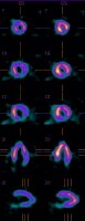 Wall motion abnormalities in inferobasal region. 