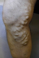 Varicose vein before treatment with endovenous las