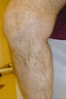 Varicose vein after treatment with endovenous lase