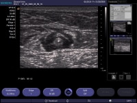 Transverse ultrasound image of tumescent anestheti