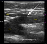 Longitudinal (sagittal) duplex ultrasound image of
