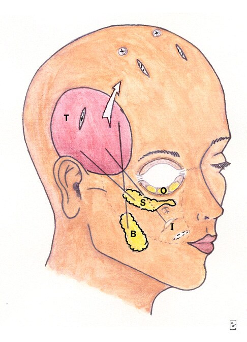 The buccal fat pad of Bichat (B) is suspended most medially and most The buccal fat pad of Bichat (B) is suspended most medially and most