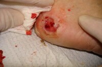 Neuropathic heel ulcer. A 68-year-old diabetic fem