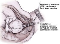 Fetal Scalp Sampling
