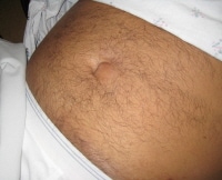Umbilical Hernia In An Adult 49