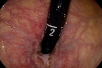 Retroflex of anal canal Girl fucked and has orgasim
