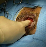 pph hemorrhoidectomy