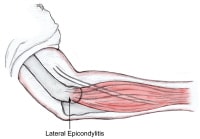 Complications of steroid injection for tennis elbow